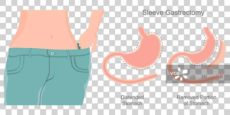 减重手术旨在帮助减掉多余的体重图片素材
