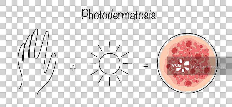 光敏性皮肤病图片素材