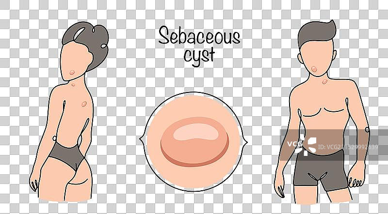 皮脂囊肿图片素材