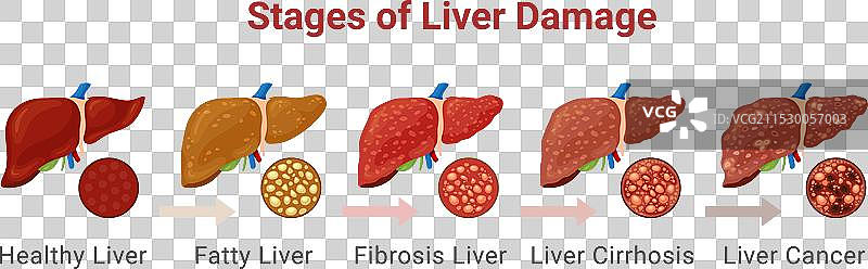 肝脏损伤阶段信息图医疗方案图片素材