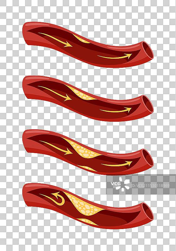 动脉粥样硬化阶段图标集 心脏解剖结构图片素材