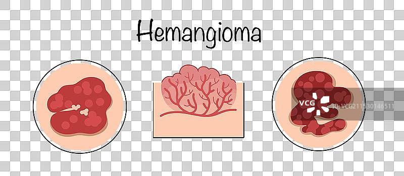 血管瘤图片素材