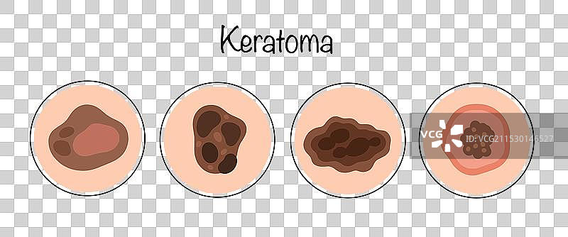 角质瘤图片素材