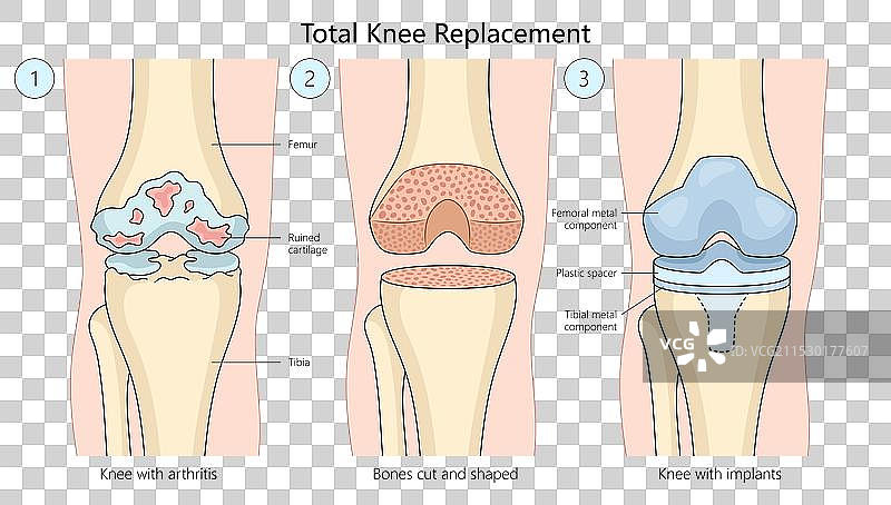 全膝关节置换手术医学科学图片素材