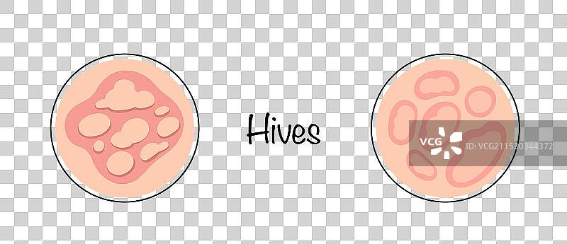 荨麻疹图片素材