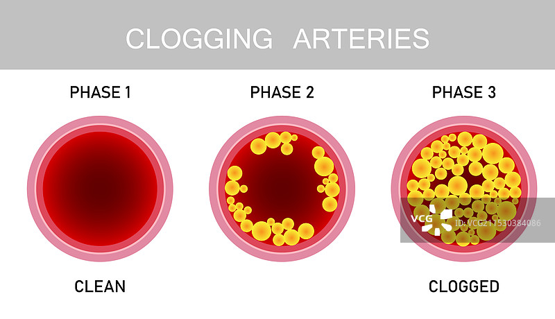 动脉堵塞与动脉中的胆固醇健康图片素材