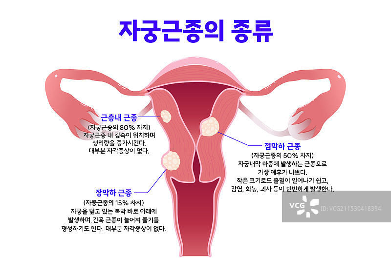 子宫、宫颈癌、子宫肌瘤图片素材