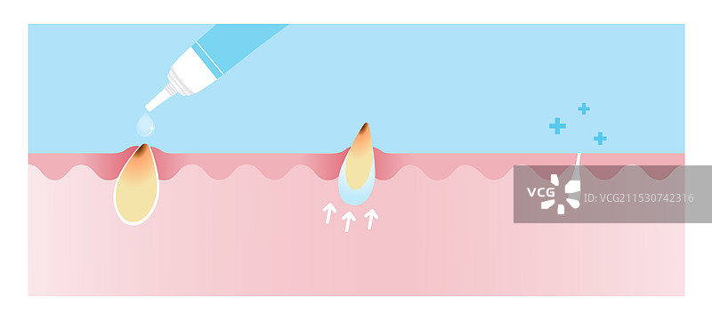 黑头去除凝胶图片素材