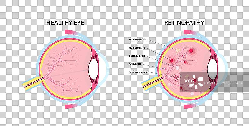 糖尿病相关视网膜病变图片素材