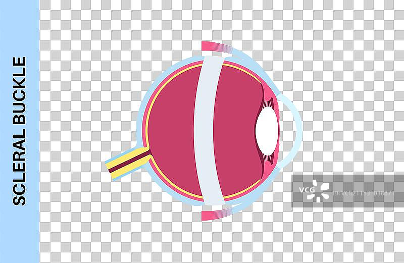 巩膜带手术图片素材