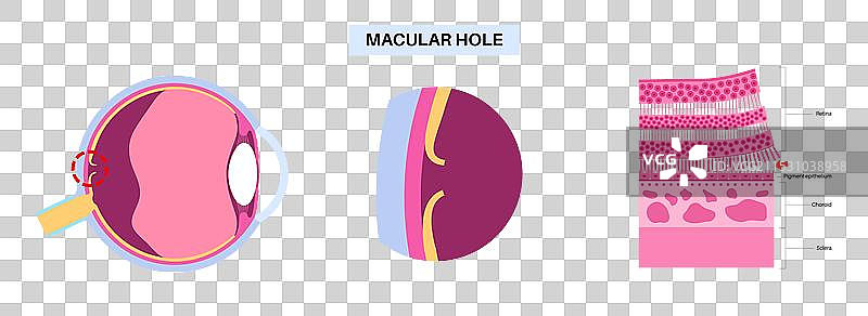黄斑孔疾病图片素材