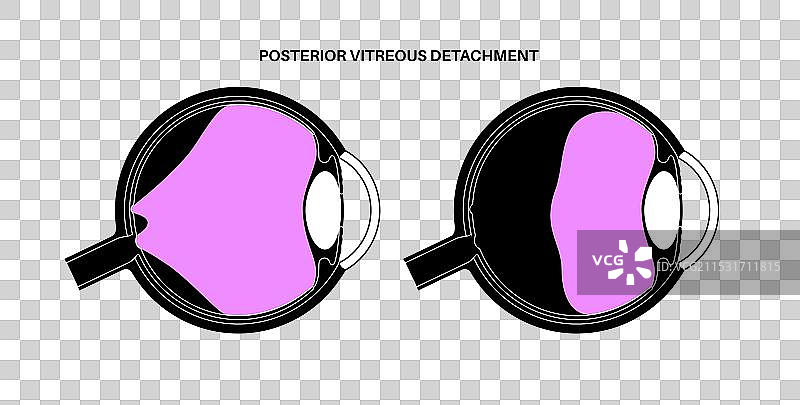 后玻璃体脱离图片素材