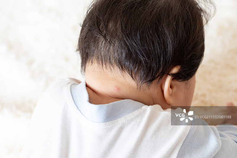 婴儿的脖子被蚊子叮了图片素材