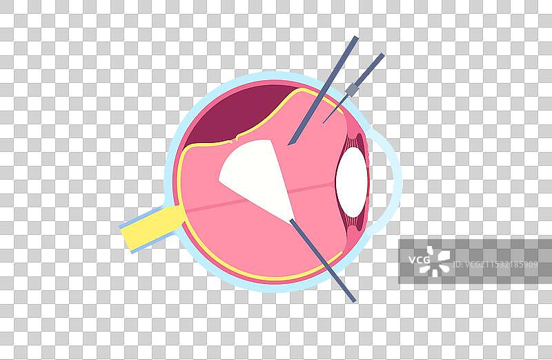 玻璃体切除手术海报图片素材