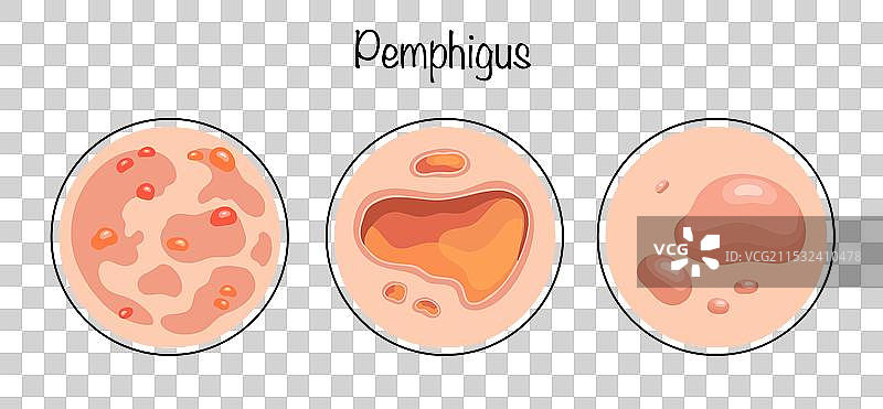天疱疮图片素材