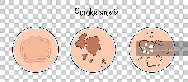 角化病图片素材