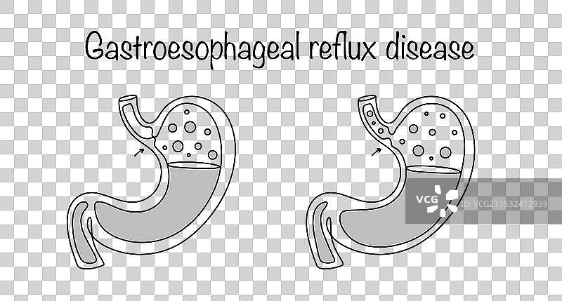 胃食管反流病图片素材
