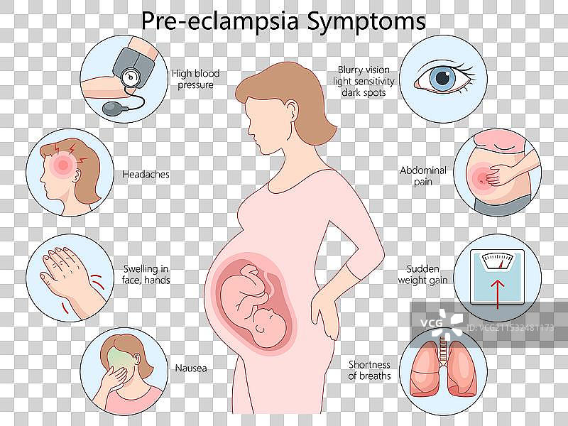 妊娠期高血压症状图片素材