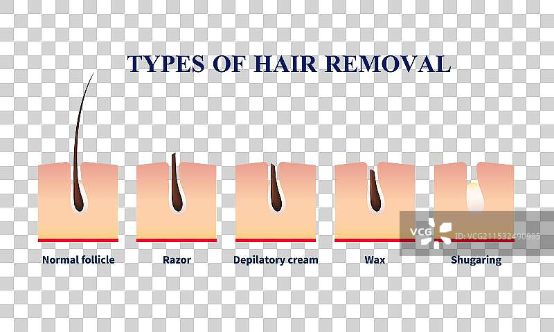 脱毛的类型图片素材