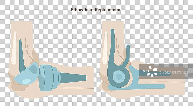 关节植入受伤或分心的人类图片素材