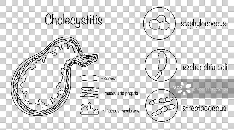 胆囊炎图片素材