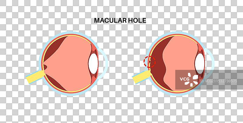 黄斑孔疾病图片素材