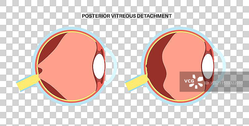 后玻璃体脱离图片素材