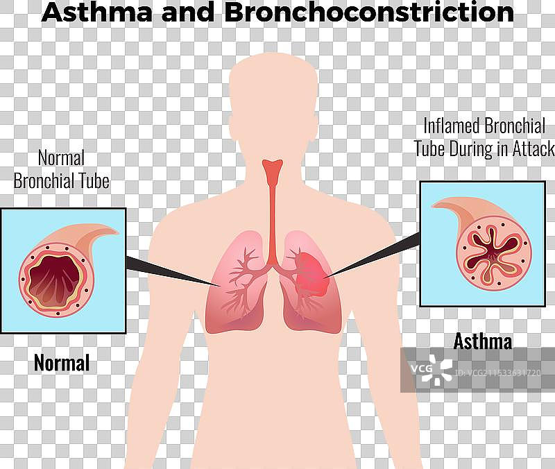 哮喘医学海报图片素材
