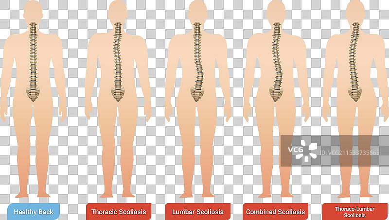 脊柱弯曲信息图集图片素材