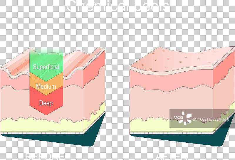 化学去角质美容美学治疗图片素材