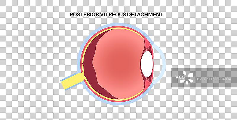 后玻璃体脱离图片素材