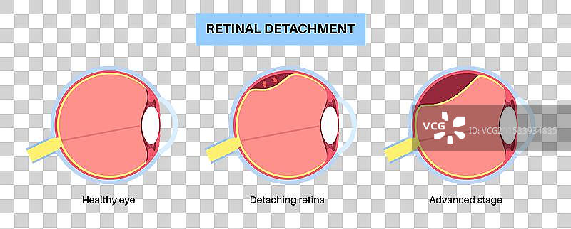 视网膜脱离眼病图片素材