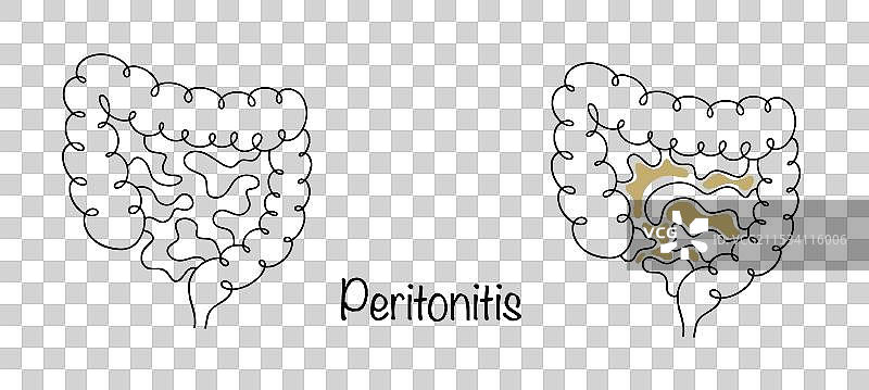 腹膜炎图片素材