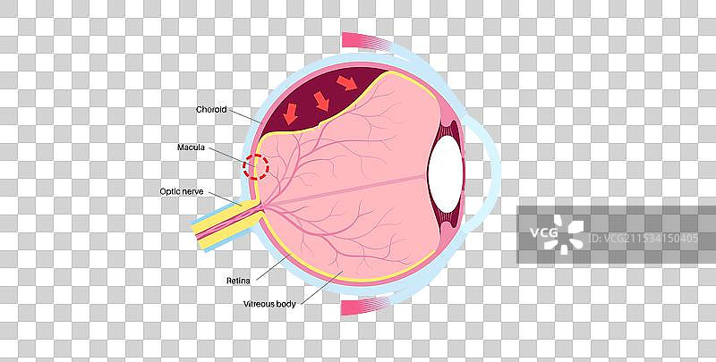 视网膜脱离眼病图片素材