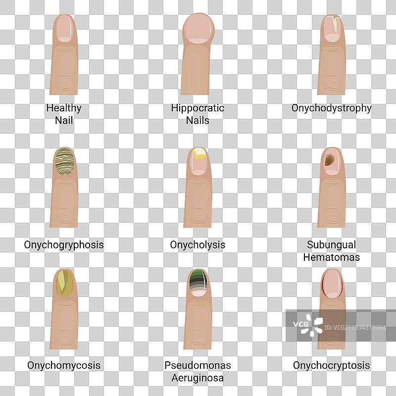 指甲疾病设计图片素材