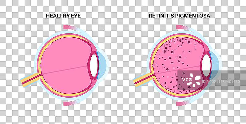 视网膜色素变性海报图片素材