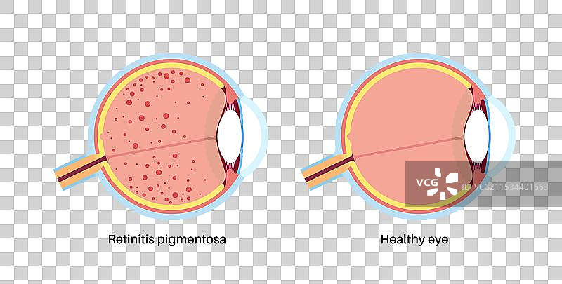 视网膜色素变性海报图片素材
