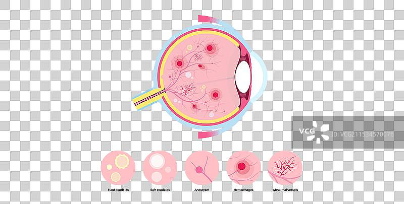 糖尿病相关视网膜病变图片素材