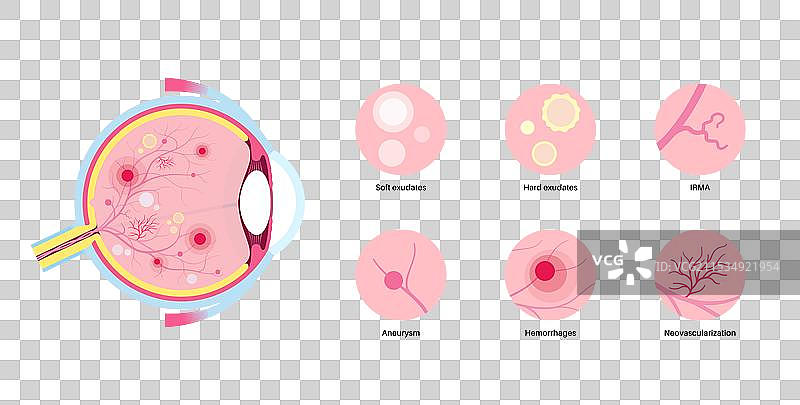 糖尿病相关视网膜病变图片素材