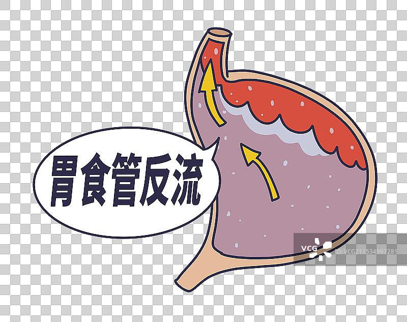 胃食管反流，健康疾病图片素材