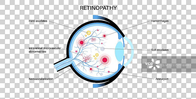 糖尿病相关视网膜病变图片素材