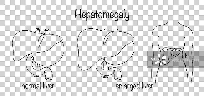 肝肿大图片素材