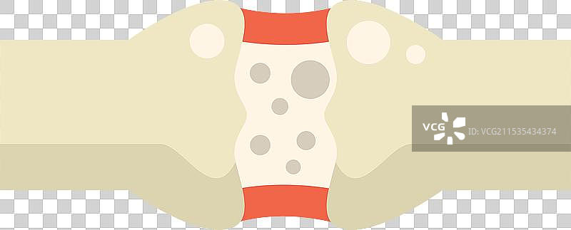 显示骨质疏松症影响骨骼的人类关节图片素材