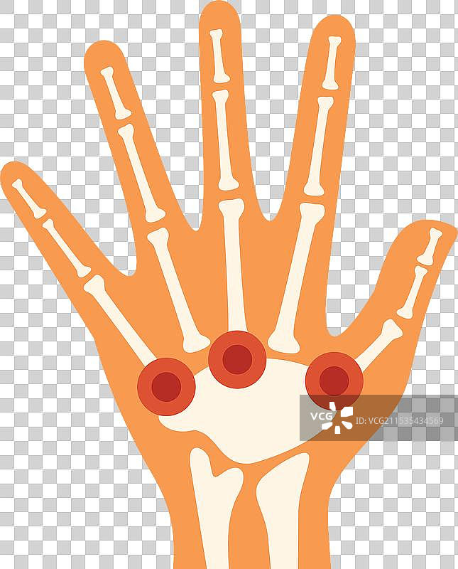 人手显示类风湿关节炎症状图片素材