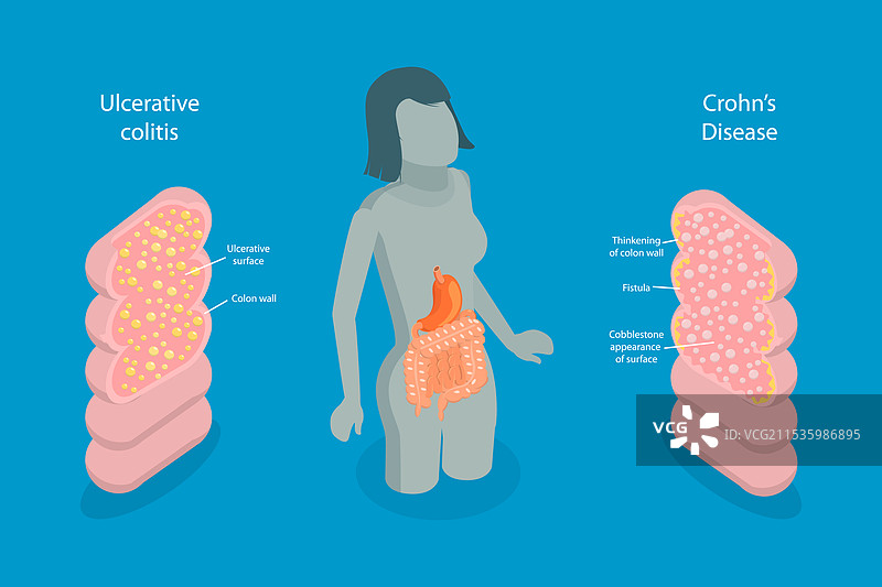 炎症性肠病的三维等距平面图图片素材