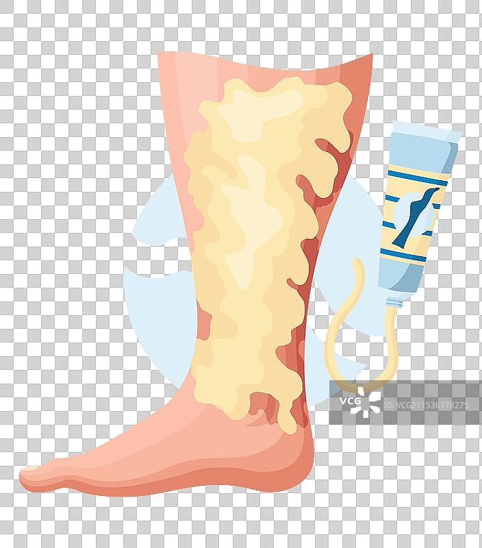 静脉曲张发展的阶段或类型图片素材