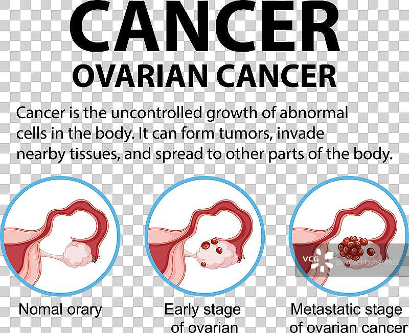 女性卵巢癌信息图表：分期与治疗图片素材