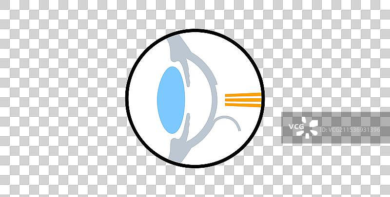 激光矫正视力手术图片素材