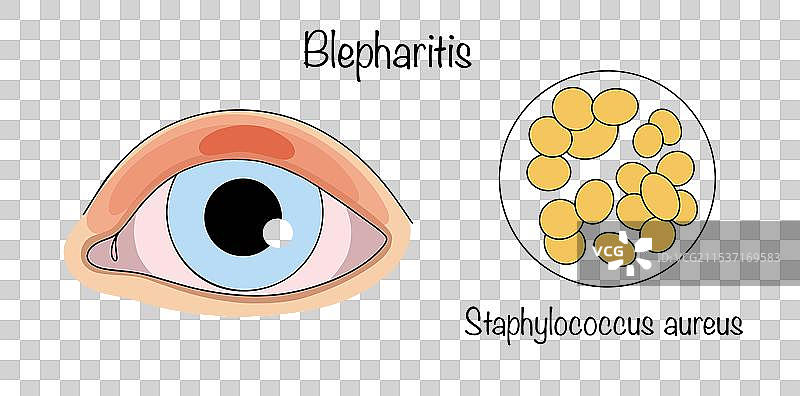 睑炎图片素材