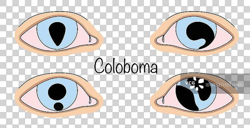 眼裂畸形图片素材